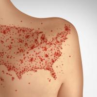 Measles infections send 1 in 5 people to the hospital. Measles infections send 1 in 5 people to the hospital.